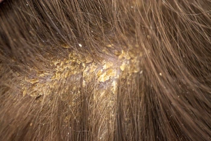 mengobati dermatitis seboroik pada orang dewasa