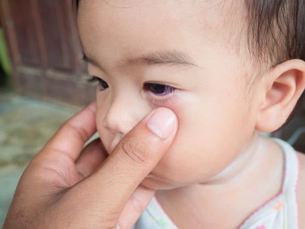 penyebab mata panda pada anak