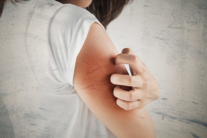 obat penyakit eksim dermatitis atopik