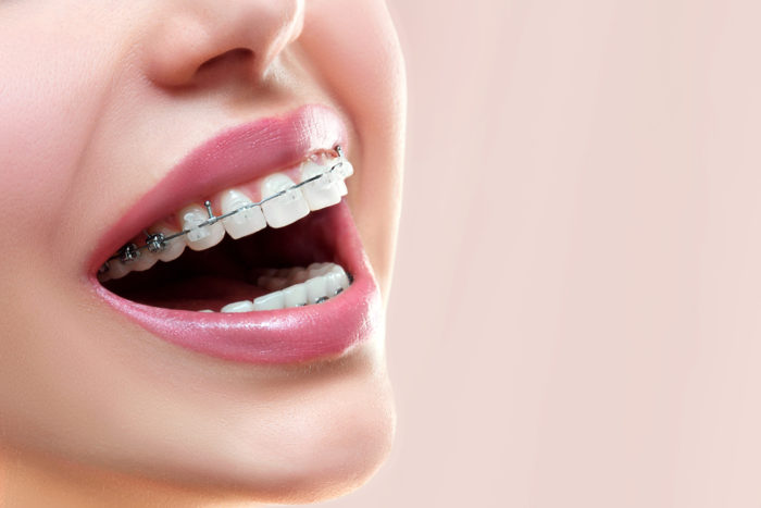merapikan gigi kawat invisalign