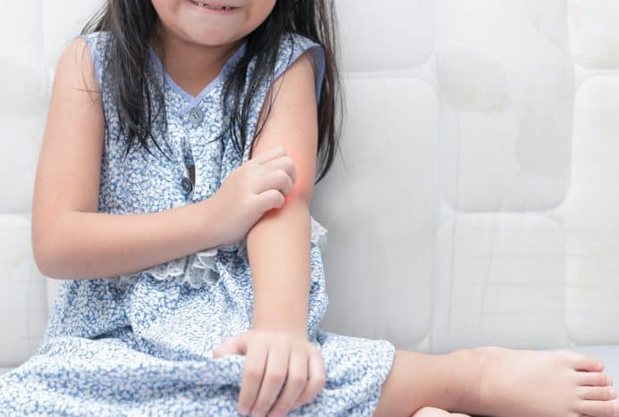 alergi makanan pada anak