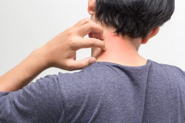 badan gatal setelah minum alkohol