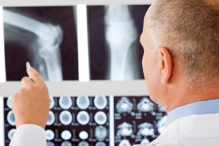 perbedaan osteopenia dan osteoporosis