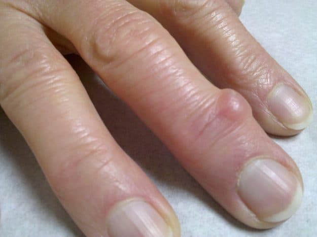 5 Penyebab Terjadinya Benjolan Di Jari Tangan Dan Kaki