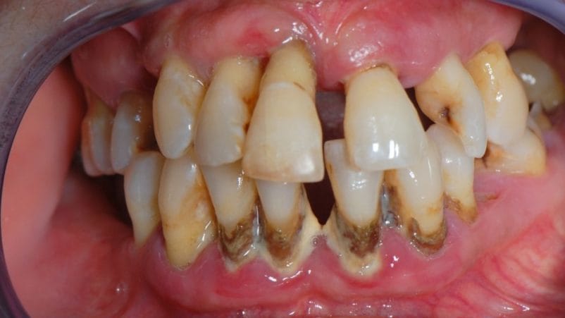 Periodontitis