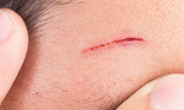 Besar luka perlu dijahit