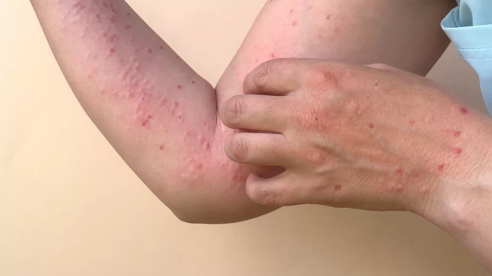 Kemenkes: Kasus Monkeypox Bertambah di Indonesia Akibat Sex Berisiko